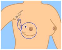 India Surgery Breast Cancer,Breast Cancer,India Surgery Breast Cancer,Cost Breast Cancer,Breast Cancer Stages
