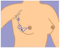 India Surgery Breast Cancer,Breast Cancer,Breast Cancer Surgery India, Cost Breast Cancer,Breast Cancer Stages, Breast Cancer