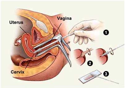 How can you prevent cervix cancer?