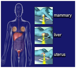 India High Intensity Ultrasound Cost,High Intensity Focused Ultrasound,Therapy Replace Conventional Surgery, High Intensity Focused Ultrasound Treatment, High Intensity, Hifu, High Intensity Focused Ultrasound, Hifu Specialist, Hifu Prostate Cancer, Miami Hifu, Hifu Treatment, High Intensity Focused Ultrasound Hospitals, India Noninvasive, Surgery, Cryotherapy, Cryocare