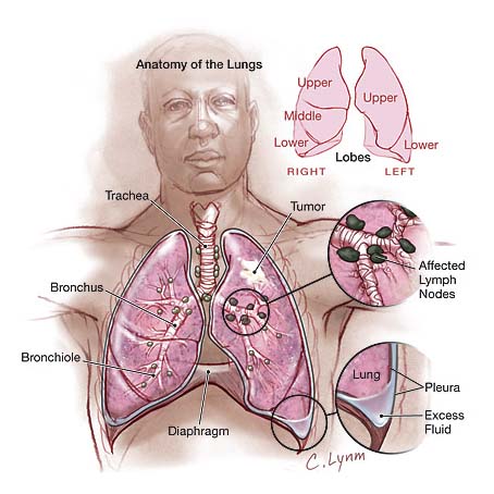 Lung Cancer Treatment, India Surgery Lung Cancer Treatment, India Surgery Lung Cancer Symptoms