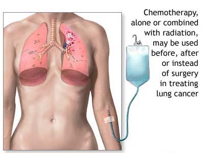 Treatment of Lung Cancer in