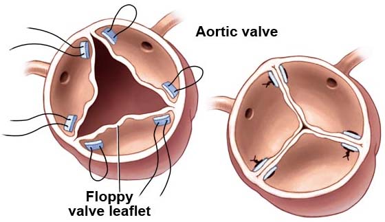 Surgery India Pediatric Aortic Valve Replacement, Pediatric Aortic Valve Replacement, India Aortic Valve Surgery, Surgery India Tour
