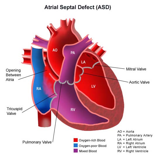 Surgery India Pediatric Heart,India Cost Atrial Septal Defect Surgery, India Atrial Septal Defect Surgery, India Flooding
