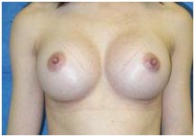Surgery India Breast Augmentation, Breast Augmentation Surgery