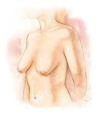 Surgery India Breast Lift Surgery, Breast Lift Surgery, India Breast Lift Surgery