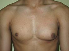 India Cost Gynaecomastia Surgery, Gynaecomastia Surgery, India Gynaecomastia, India Male Breast Reduction Surgery