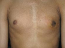Surgery India Gynaecomastia Surgery, India Gynaecomastia, India Male Breast Reduction Surgery