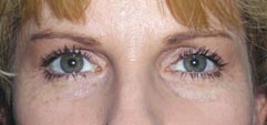 Surgery India Blepharoplasty,Eye Lid, Blepharoplasty Eye Lid Surgery