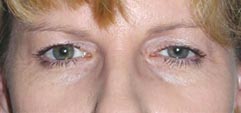 India Cost Blepharoplasty Surgery,Eye Lid, India Blepharoplasty