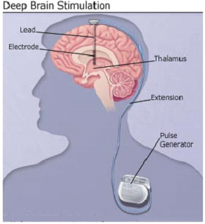 India Surgery Deep Brain Stimulation, Brain Stimulation surgery, India Deep Brain Stimulation Surgery India Stimulation