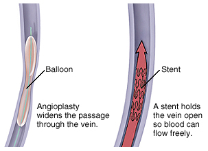 Venous Angioplasty Surgery Related Symptoms, India Venous Angioplasty Surgery Kolkata, India Signs, India Signs And Symptoms, India Venous Angioplasty Surgery Medical Symptoms, India Angioplasty Surgery, India Causes Of Venous Angioplasty, India low cost Venous Angioplasty Surgery, India Venous Angioplasty In Children Causes