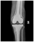 Cost Knee Revision Surgery, Revision Knee Replacement, India Revision Surgery, Knee Revision Treatment