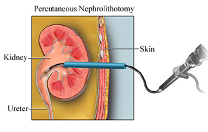 India Surgery Percutaneous Nephrolithotomy, Cost Nephrolithotomy Mumbai, Percutaneous Nephrolithotomy Surgery