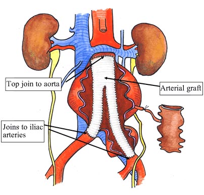 aortic aneurysm symptoms. Abdominal Aortic Aneurysm,