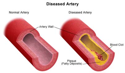 Surgery India Carotid Artery Stenosis, Cost Carotid Artery-Stenosis
