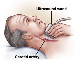 Surgery India Carotid Artery Disease, Carotid Artery Disease
