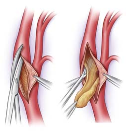 Surgery India Carotid Artery Disease, India Cost Carotid Artery Disease, India Atherosclerosis