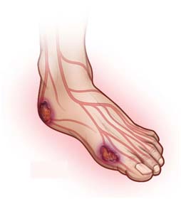 Surgery India Diabetic Foot Ulcer Treatment, India Affordable Diabetic Foot Ulcer IND, India Diabetic Foot Ulcers