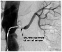 Surgery India Renovascular Conditions, Renovascular, India Kidney, India Artery Stenosis