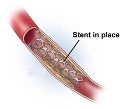 India Cost Stenting Placement, Balloon Catheter