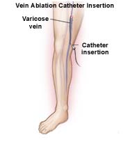 Surgery India Vein Ablation Surgery, India Cost Vein Ablation Surgery