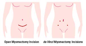 Uterus Fibroid Surgery India, Cost Uterus Fibroid Removal Surgery India,Myomectomy Vaginal Fibroid Removal Surgery