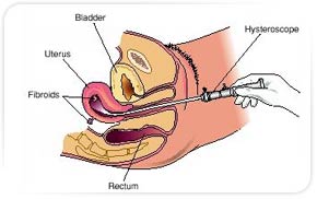 Hysteroscopy, Hysteroscopy India, Procedure of Hysteroscopy, Surgical Procedure, uterus, endometrial cavity