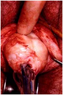 Laparoscopic Assisted Vaginal Myomectomy (LAVM), Laparoscopic Myomectomy with Mini-Laparotomy, Hysteroscopic Myomectomy, Abdominal Myomectomy