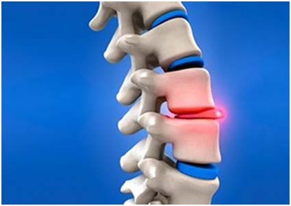 info on herniated disc, disc replacement surgery india, herniated disc removal treatment