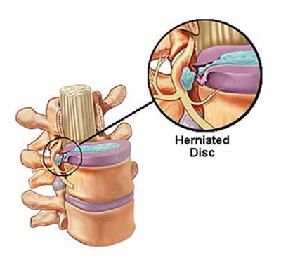 herniated disc surgery mumbai, herniated disc surgery delhi, back surgery india, herniated disc causes india, herniated disc treatment india