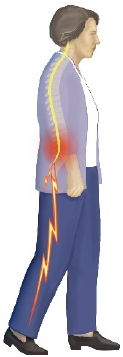 Health Care, Condition And Disease, Benefits Of X Stop Spine Surgery Procedure India, Risks X Stop Spine Surgery India, X-Stop Spinal Surgery For Patients India