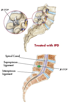 X Stop Spine Surgery Procedure, X Stop, Spine Surgery ProcedureSpinal Stenosis India, X-Stop Implant