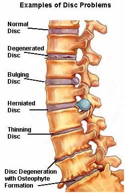Low Cost Lumbar Laminectomy Surgery India, Bone Spurs India, Side Effects India