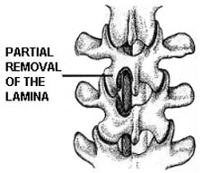 Vertebral Level India, Central Tube, Spinal Surgery, Lumbar Laminectomy India, Spine Health, Lumbar Surgery, Patient Education