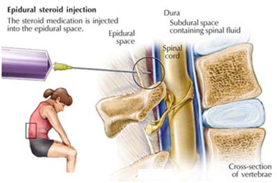 Transforaminal epidural steroid injections lumbosacral radiculopathy