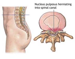 Spinal Stenosis Surgery, Cervical Stenosis, Cervical Stenosis Surgery, Laminectomy, Lumbar Spinal Stenosis